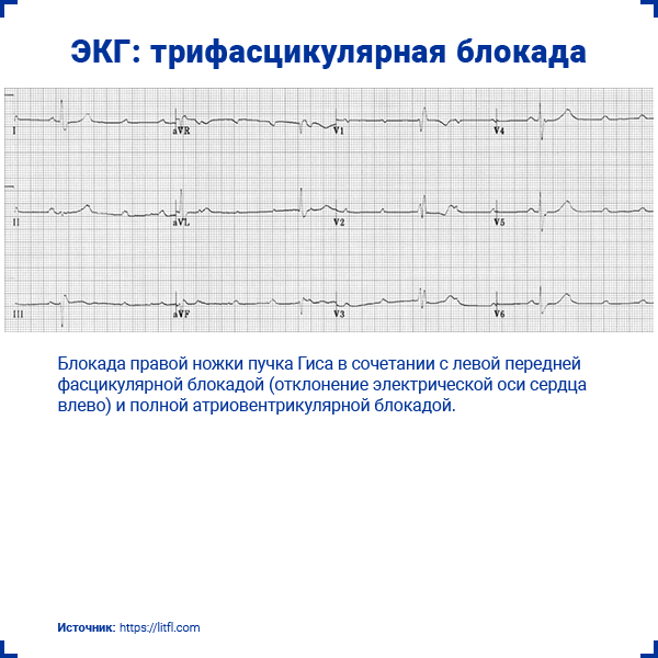 ЭКГ трифасцикулярная блокада